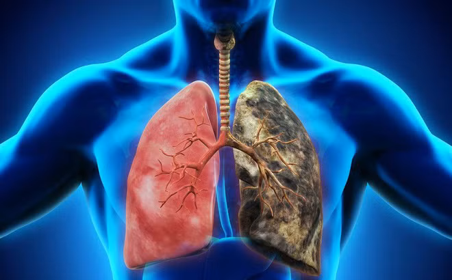 According to experts, smoking or passive smoking has been identified as a major cause of lung cancer among young people.
