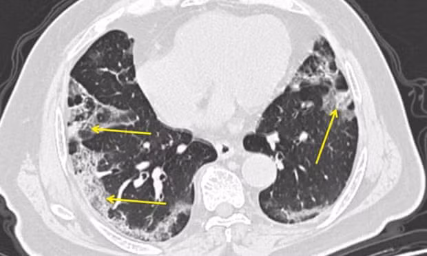 Respiratory physician John Wilson explains the range of Covid-19 impacts. This image shows a CT scan from a man with Covid-19. Pneumonia caused by the new coronavirus can show up as distinctive hazy patches on the outer edges of the lungs, indicated by arrows. Photograph: Mount Sinai Hospital/AP Respiratory physician John Wilson explains the range of Covid-19 impacts. This image shows a CT scan from a man with Covid-19. Pneumonia caused by the new coronavirus can show up as distinctive hazy patches on the outer edges of the lungs, indicated by arrows. Photograph: Mount Sinai Hospital/AP
