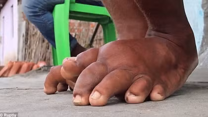 Vietnam Eliminates Debilitating Disease, Lymphatic Filariasis