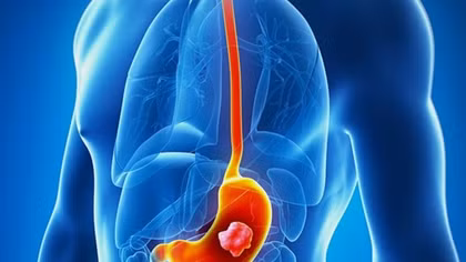 Vietnam 18th in global highest rate of gastric cancer
