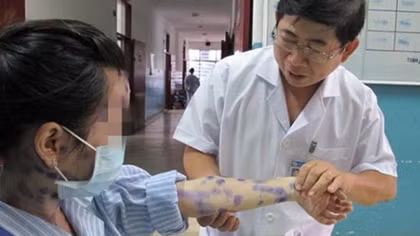 Ministry of Health warns about chickenpox outbreak in Hanoi