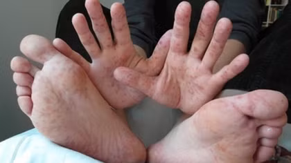 Experts concern over virus Enterovirus 71