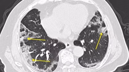 Coronavirus: what happens to people's lungs if they get Covid-19?