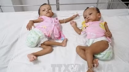 Doctors in HCM City separate conjoined twins successfully