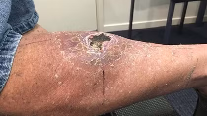 Flesh-Eating disease increasing at alarming rate in Australia