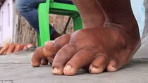 Vietnam Eliminates Debilitating Disease, Lymphatic Filariasis