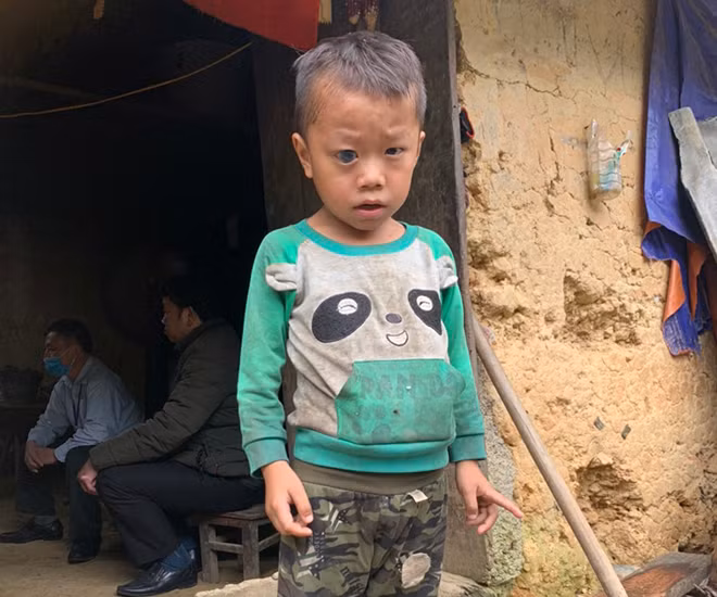 Dia at his house in Dong Van district. Dia's family was too far from the hospital so his parents decided to use some herbs to treat his eye but it did not work. Dia at his house in Dong Van district. Dia's family was too far from the hospital so his parents decided to use some herbs to treat his eye but it did not work.